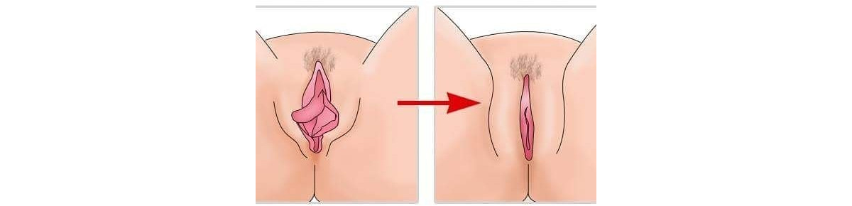 Labioplastia – O bem estar com sua intimidade