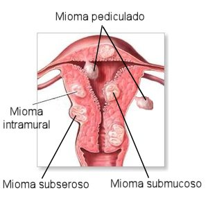 Mioma