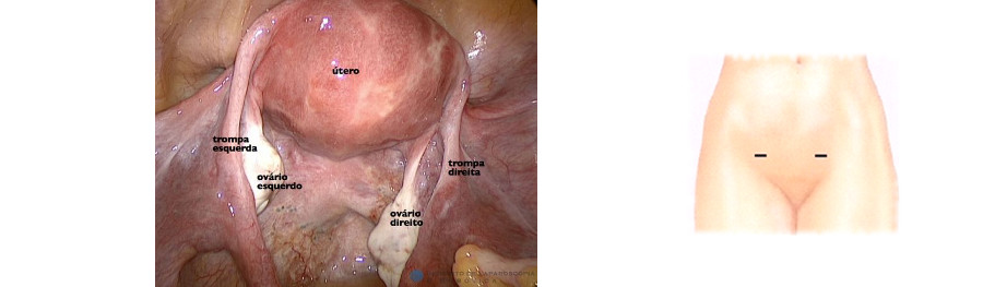 Videolaparoscopia em Ginecologia